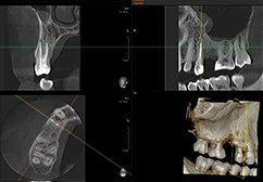 OrtoDent - endodoncija